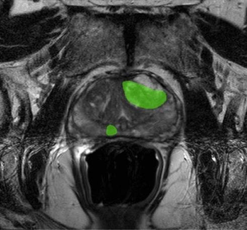 AI in Prostate Cancer