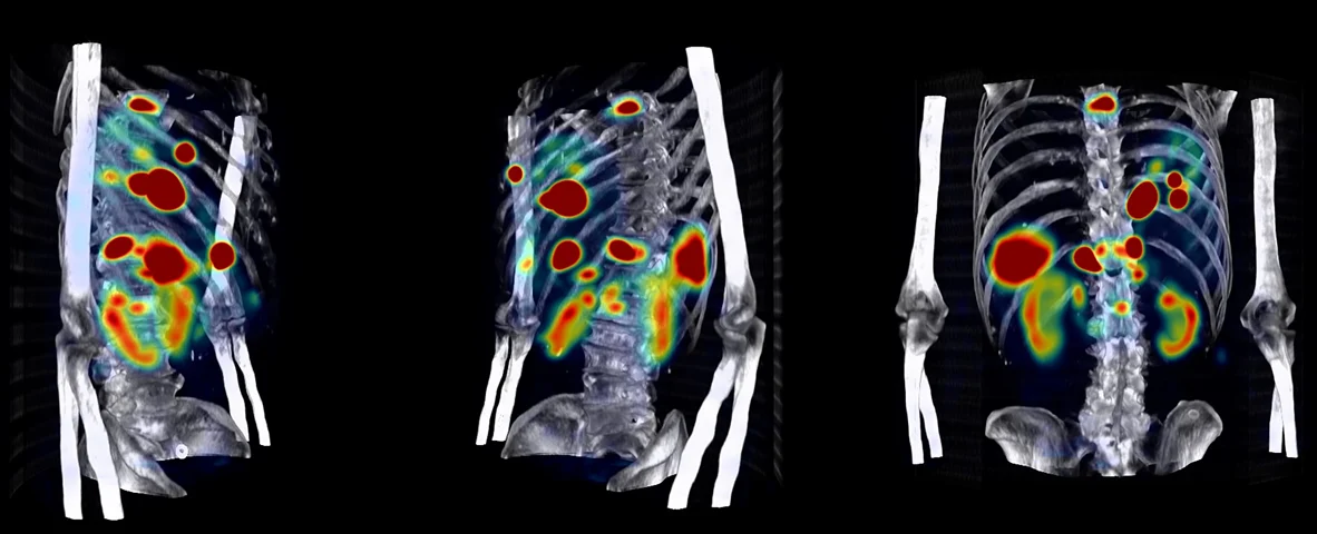 Artificial Intelligence in Oncology