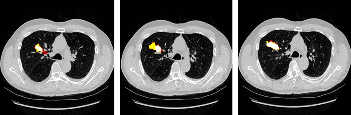 Artificial Intelligence in Oncology