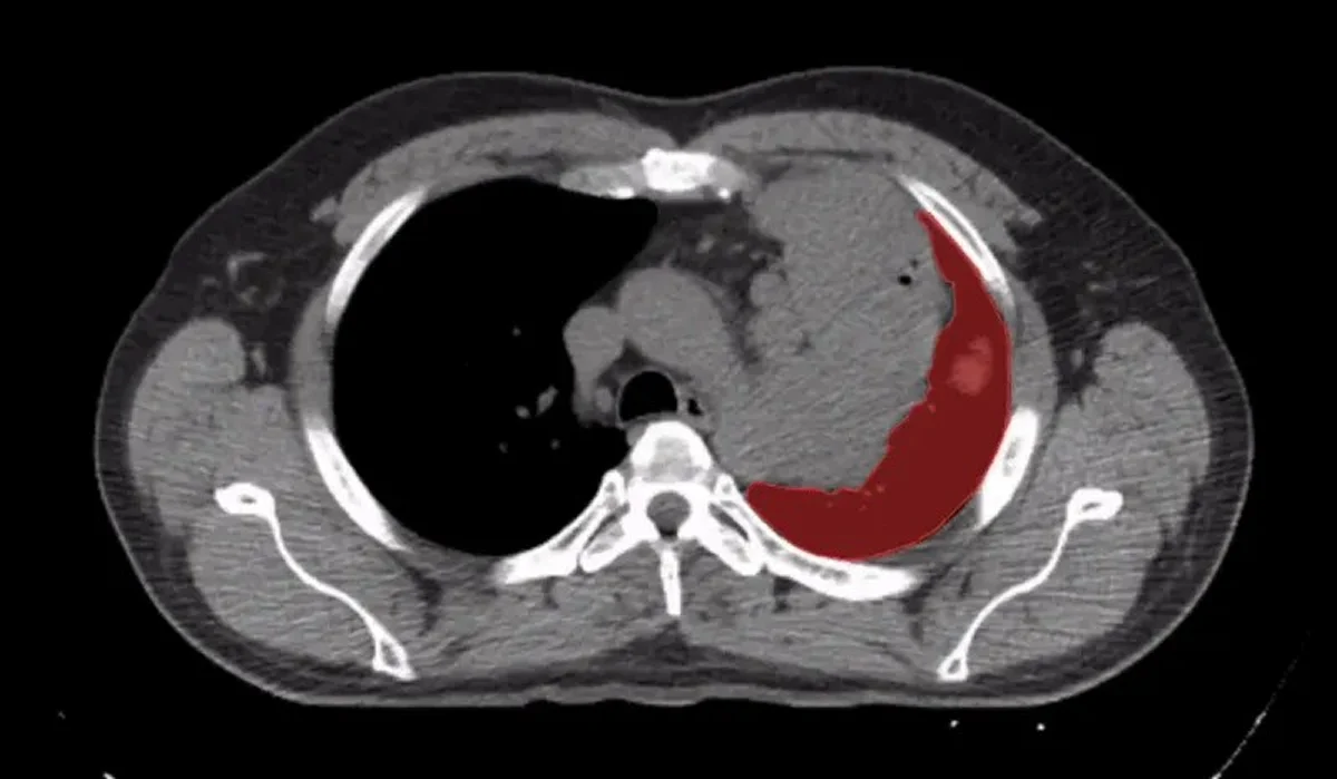 Pixel Level Segmentation in Medical Imaging